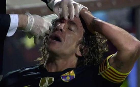 普约尔用像订书器一样的工具缝针